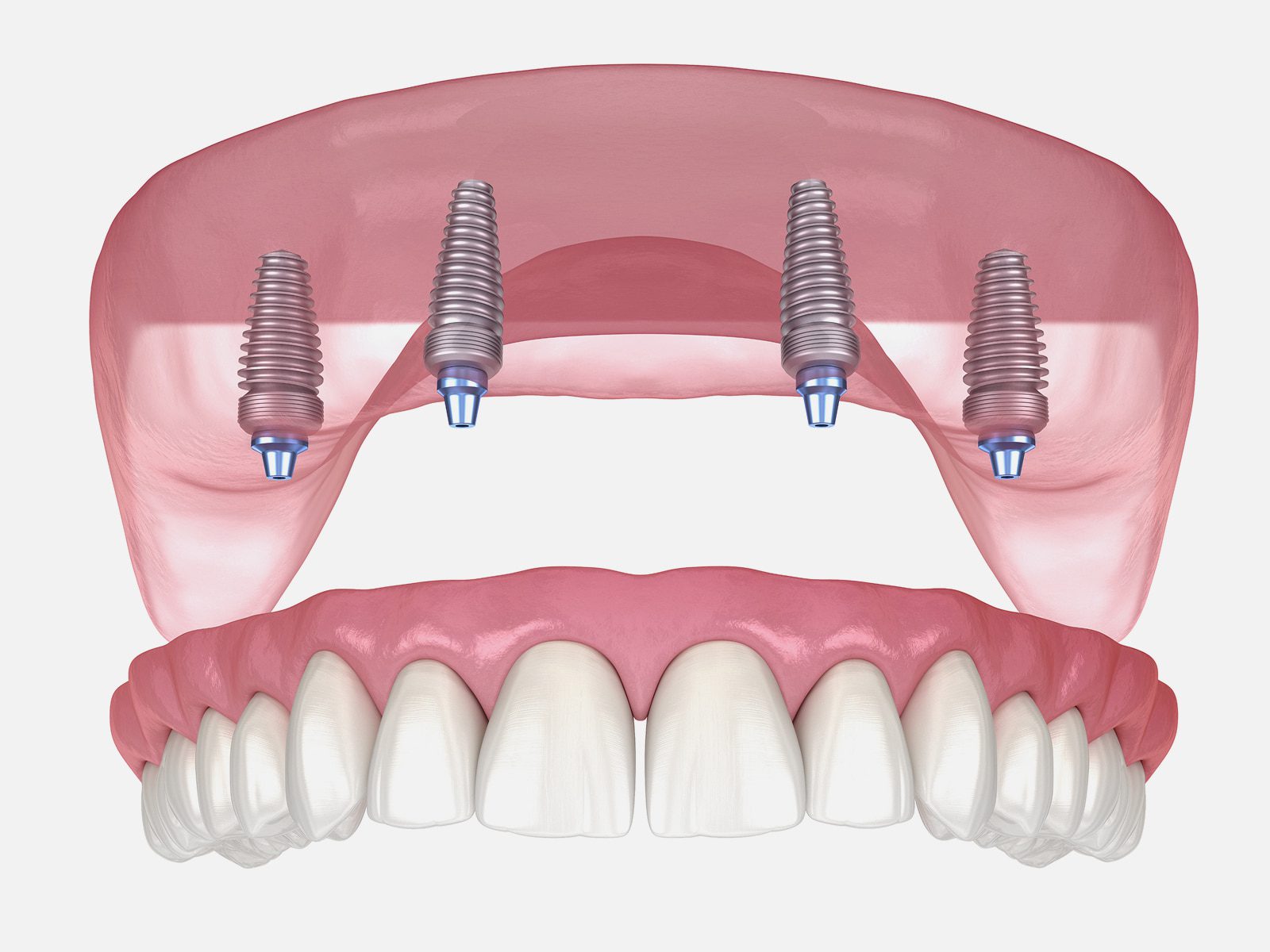 Secure implant-supported dentures for natural and stable smile