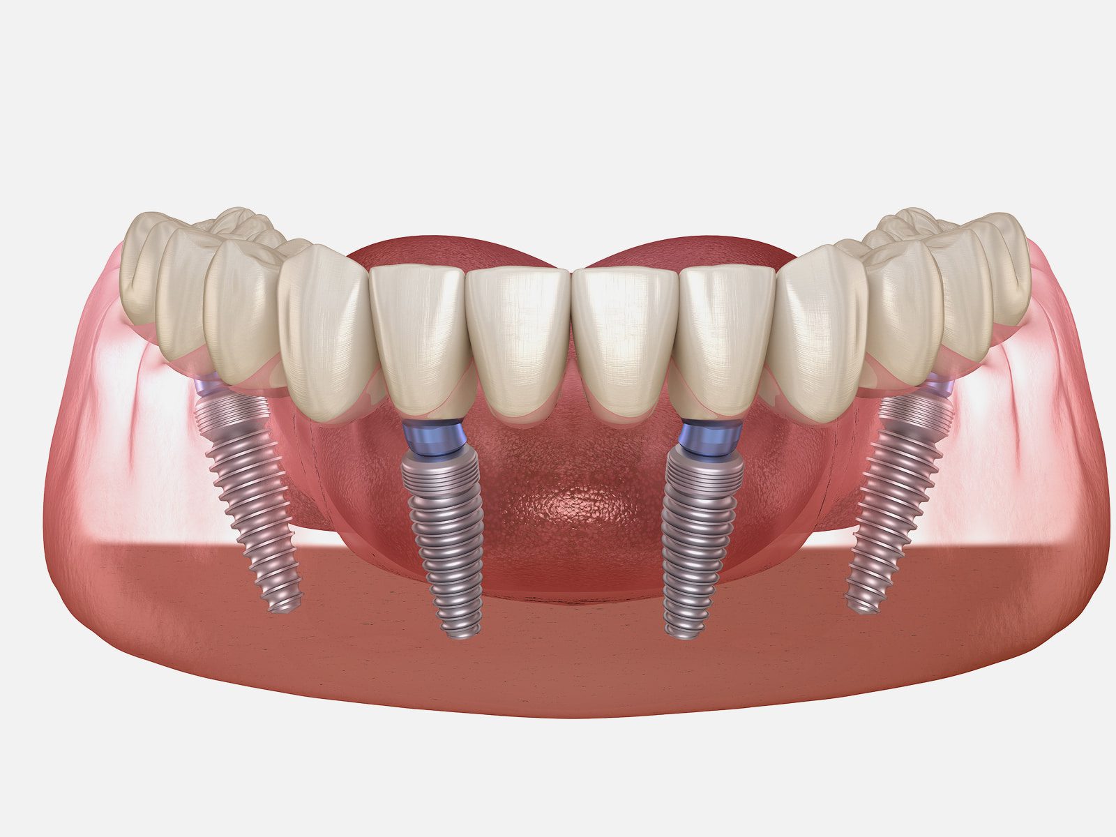 Implant dentures securely attached to jaw implants