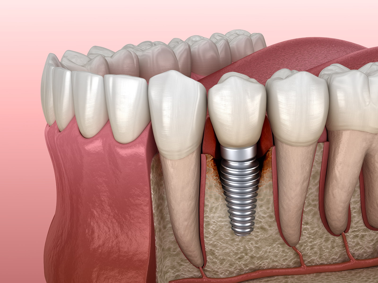 Single tooth dental implant with crown replacing a missing tooth